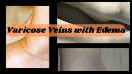 Varicose-Veins-with-Edema.jpg