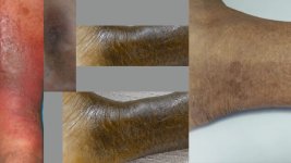 Venous-Skin-Ulcers.jpg
