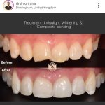 invisalign bir.jpg