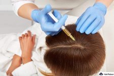 PRF-treatment-for-hair.jpg