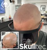 scalp micropigmentation near me.jpeg