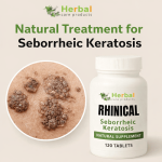 Seborrheic Keratosis Alternative Treatment.png